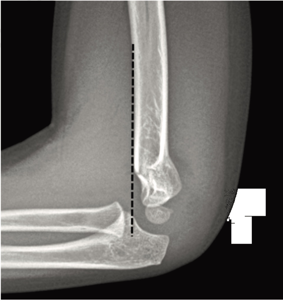 How to screen a paediatric elbow X-ray for injuries